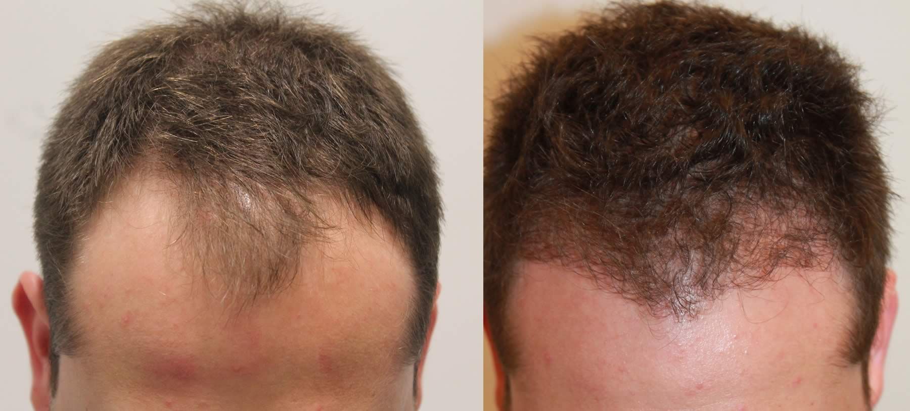 fut hair restoration
