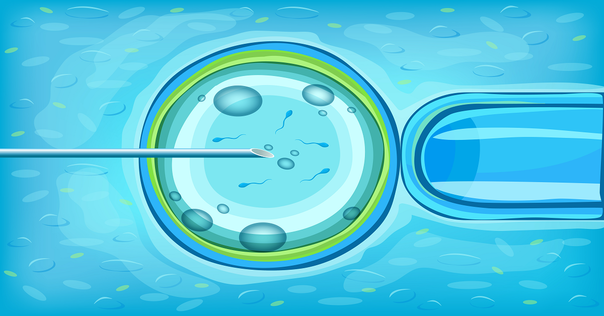 Intracytoplasmic Sperm Injection treatment